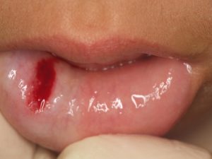 唇 できもの 粘液のう胞（粘液瘤） 治療 レーザー  越谷市 歯医者 
