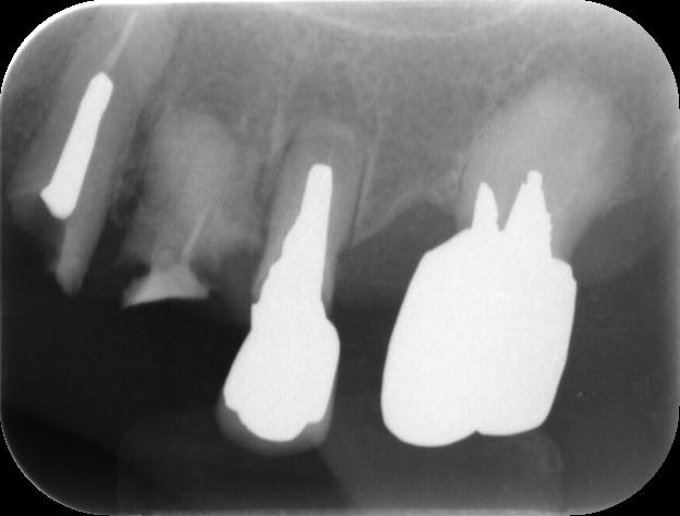 根管治療 メタルコア 除去 越谷市 歯医者 痛くない治療 口腔外科 ひろ歯科医院 無痛治療